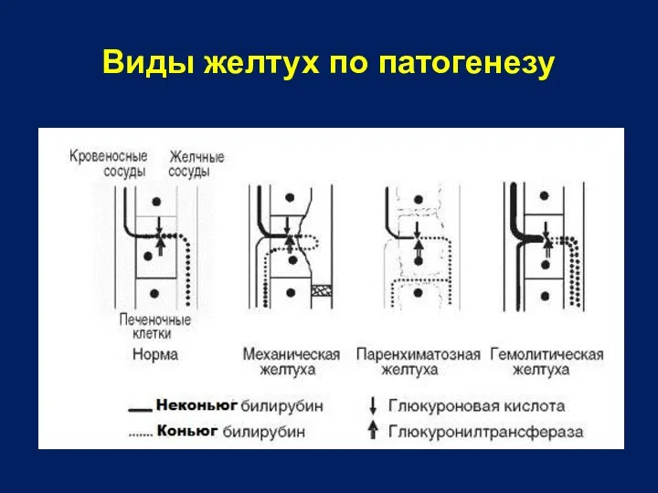 Виды желтух по патогенезу