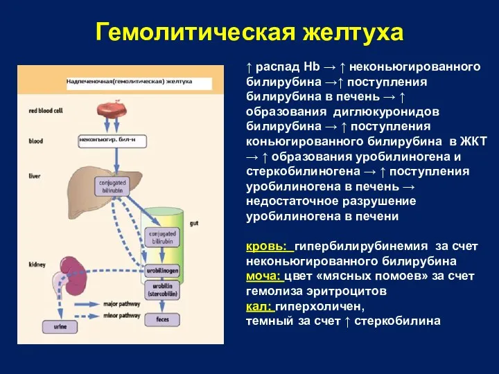 ↑ распад Hb → ↑ неконьюгированного билирубина →↑ поступления билирубина в печень →