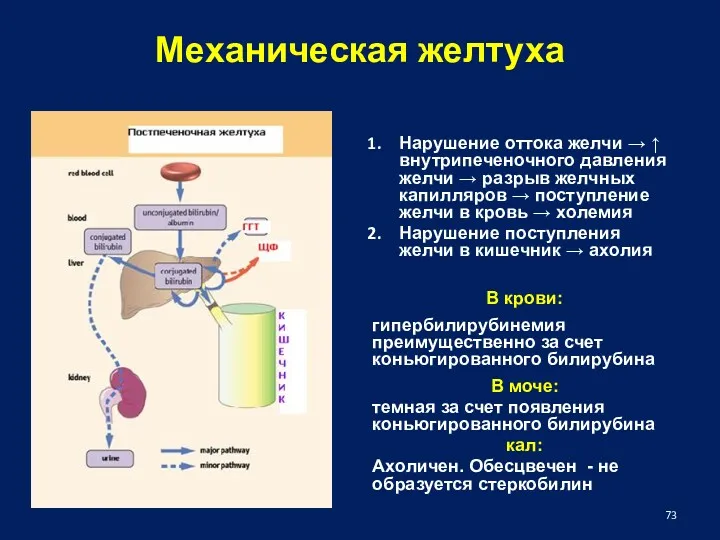 Механическая желтуха Нарушение оттока желчи → ↑ внутрипеченочного давления желчи → разрыв желчных