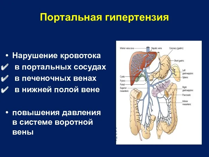 Портальная гипертензия Нарушение кровотока в портальных сосудах в печеночных венах в нижней полой