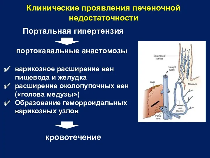 Клинические проявления печеночной недостаточности Портальная гипертензия портокавальные анастомозы варикозное расширение вен пищевода и