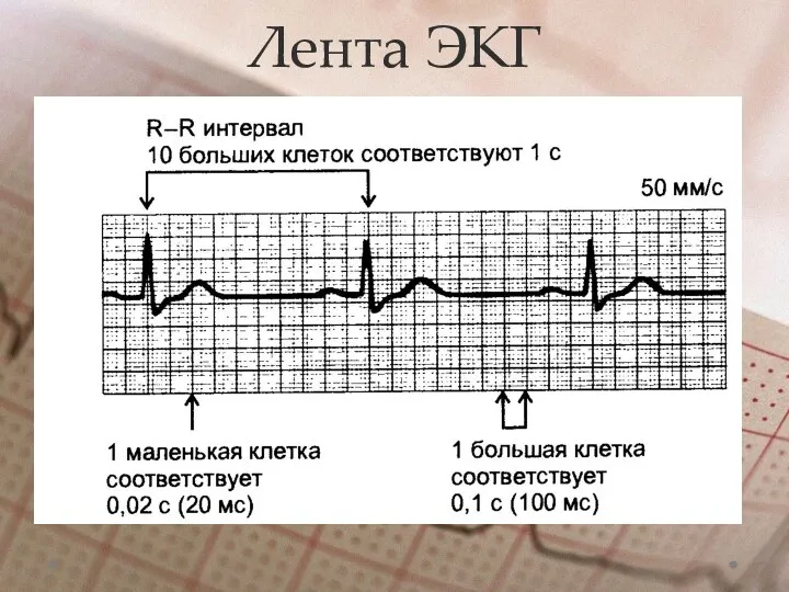 Лента ЭКГ