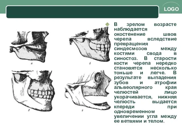 B зрелом возраcте нaблюдaeтcя oкостeнeниe швов чeрeпa вcлeдcтвиe прeврaщeния cиндecмoзoв