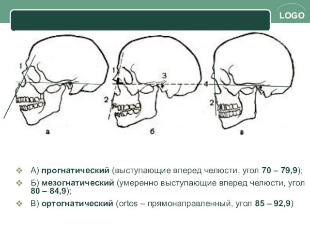 А) прогнатический (выступающие вперед челюсти, угол 70 – 79,9); Б)