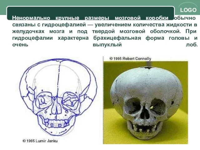 Ненормально крупные размеры мозговой коробки обычно связаны с гидроцефалией —