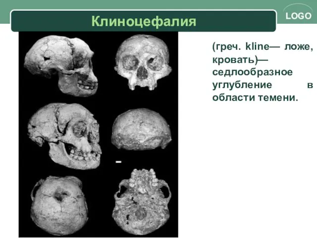 Клиноцефалия (греч. kline— ложе, кровать)— седлообразное углубление в области темени.