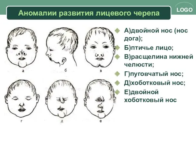 Аномалии развития лицевого черепа А)двойной нос (нос дога); Б)птичье лицо;