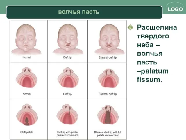 Расщелина твердого неба – волчья пасть –palatum fissum. волчья пасть