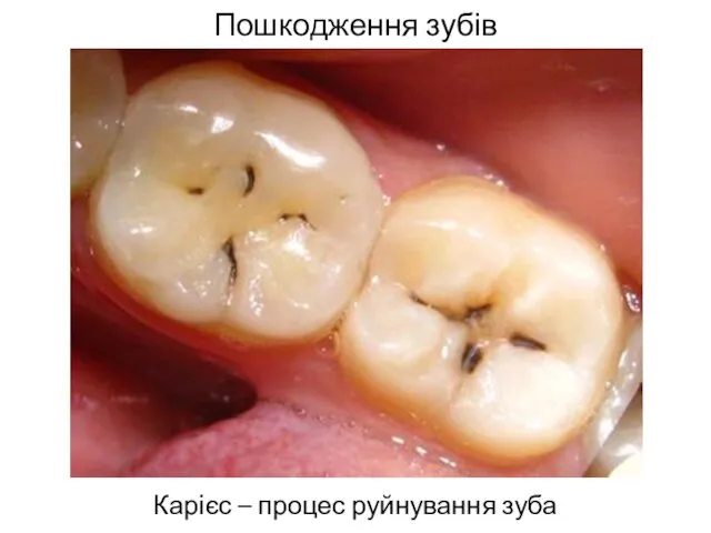Пошкодження зубів Карієс – процес руйнування зуба
