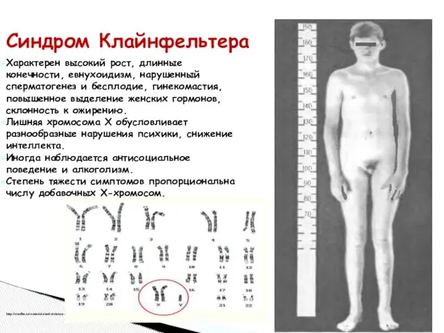 Характерен высокий рост, длинные конечности, евнухоидизм, нарушенный сперматогенез и бесплодие,