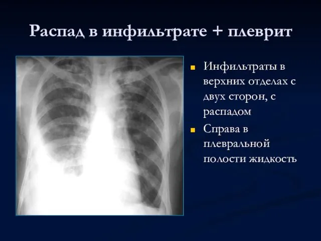 Распад в инфильтрате + плеврит Инфильтраты в верхних отделах с