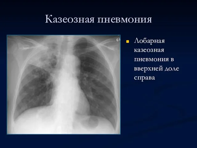 Казеозная пневмония Лобарная казеозная пневмония в вверхней доле справа