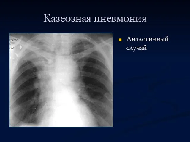 Казеозная пневмония Аналогичный случай