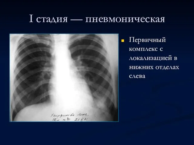 I стадия — пневмоническая Первичный комплекс с локализацией в нижних отделах слева