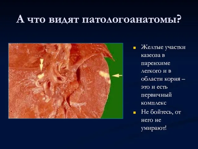 А что видят патологоанатомы? Желтые участки казеоза в паренхиме легкого