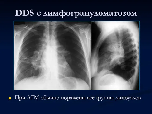 DDS с лимфогрануломатозом При ЛГМ обычно поражены все группы лимоузлов