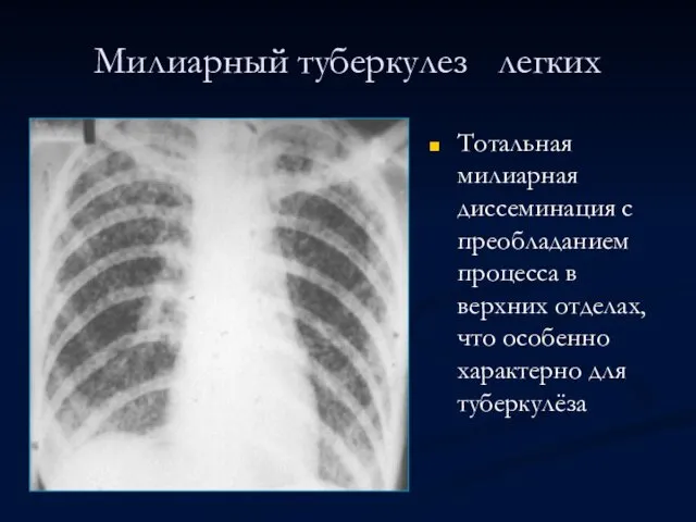 Милиарный туберкулез легких Тотальная милиарная диссеминация с преобладанием процесса в