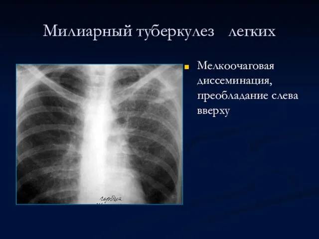 Милиарный туберкулез легких Мелкоочаговая диссеминация, преобладание слева вверху