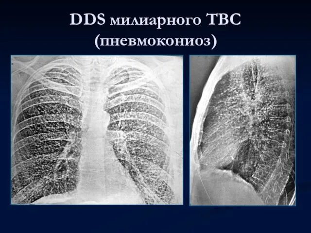 DDS милиарного ТВС (пневмокониоз)