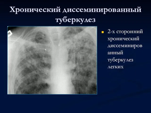 Хронический диссеминированный туберкулез 2-х сторонний хронический диссеминированный туберкулез легких