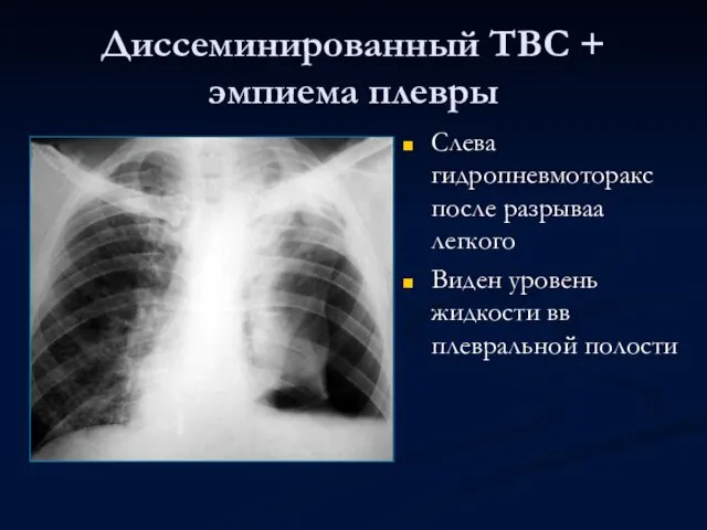 Диссеминированный ТВС + эмпиема плевры Слева гидропневмоторакс после разрываа легкого Виден уровень жидкости вв плевральной полости