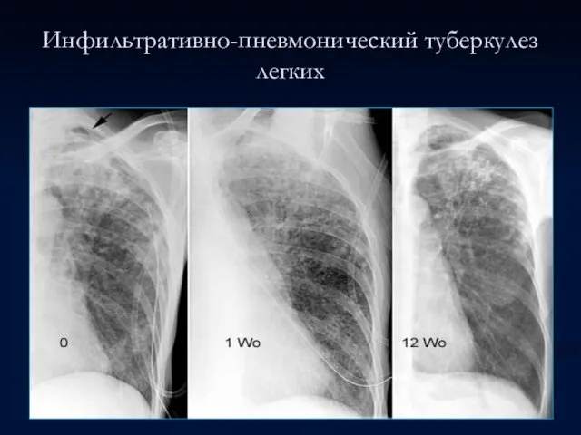 Инфильтративно-пневмонический туберкулез легких