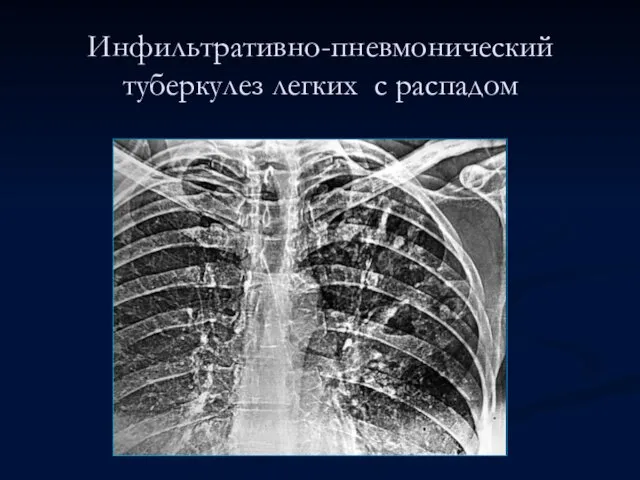 Инфильтративно-пневмонический туберкулез легких с распадом