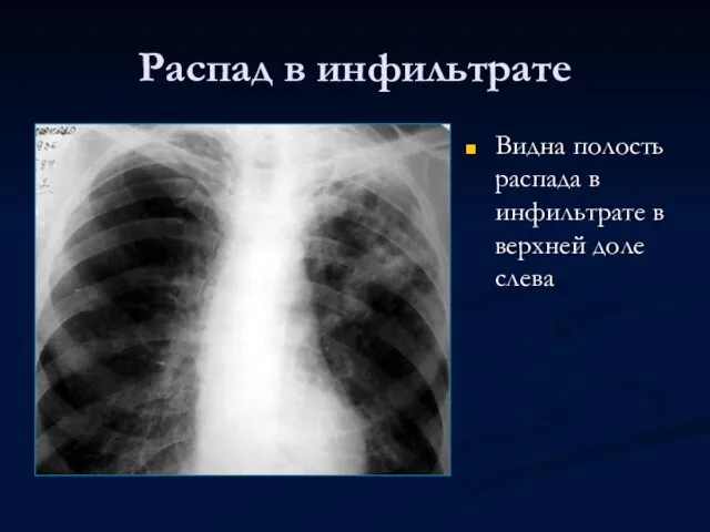 Распад в инфильтрате Видна полость распада в инфильтрате в верхней доле слева