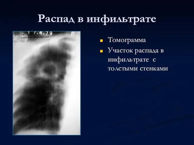 Распад в инфильтрате Томограмма Участок распада в инфильтрате с толстыми стенками