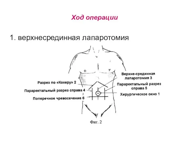 Ход операции 1. верхнесрединная лапаротомия