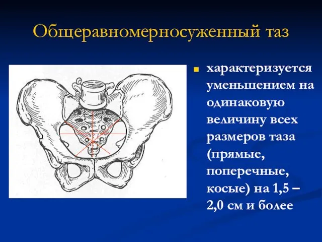 Общеравномерносуженный таз характеризуется уменьшением на одинаковую величину всех размеров таза