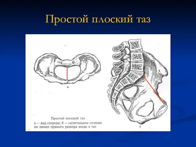 Простой плоский таз