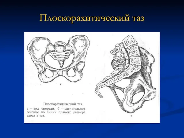 Плоскорахитический таз