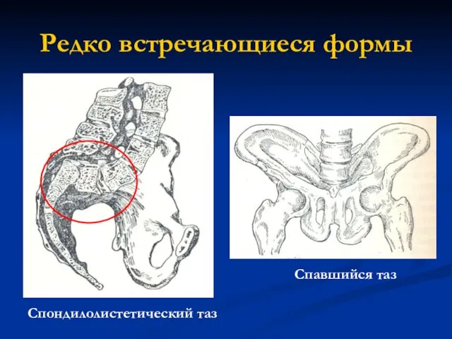 Редко встречающиеся формы Спондилолистетический таз Спавшийся таз