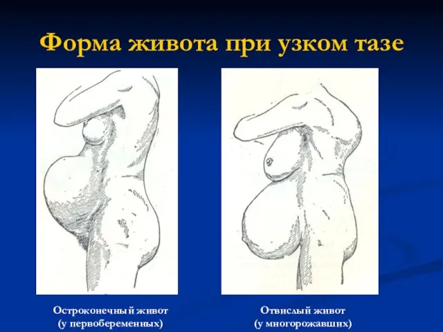 Форма живота при узком тазе Остроконечный живот (у первобеременных) Отвислый живот (у многорожавших)