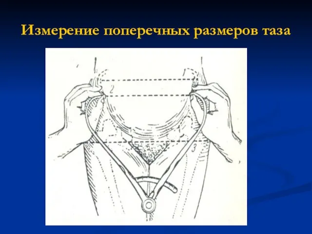 Измерение поперечных размеров таза