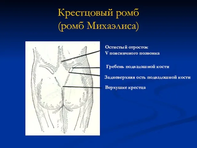 Крестцовый ромб (ромб Михаэлиса) Остистый отросток V поясничного позвонка Задневерхняя