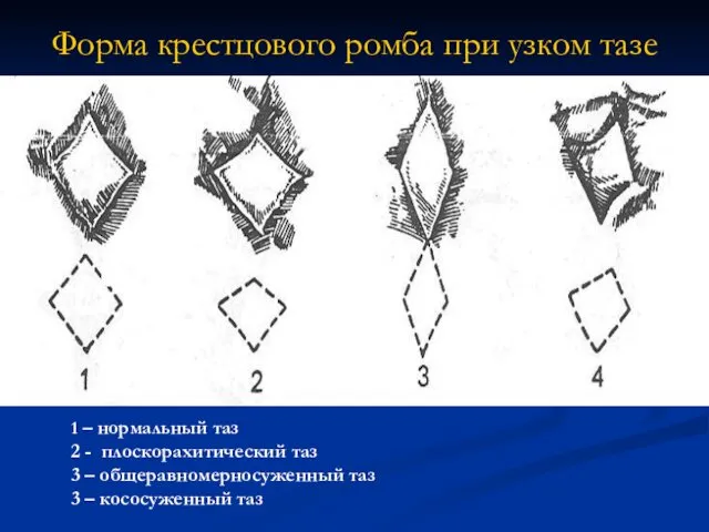 Форма крестцового ромба при узком тазе 1 – нормальный таз