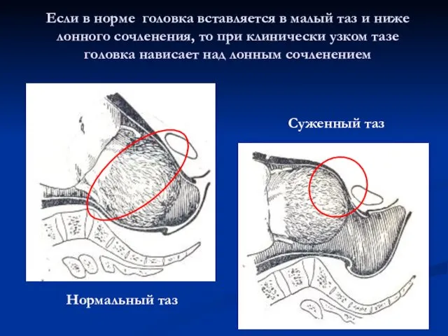 Если в норме головка вставляется в малый таз и ниже