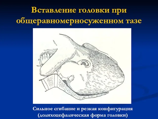 Вставление головки при общеравномерносуженном тазе Сильное сгибание и резкая конфигурация (долихоцефалическая форма головки)