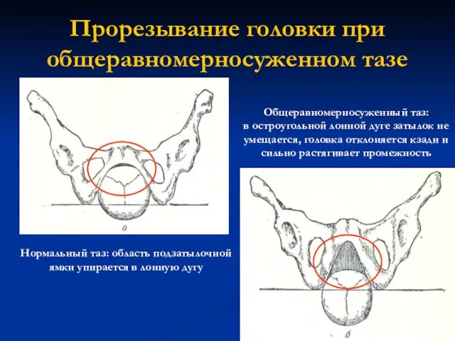 Прорезывание головки при общеравномерносуженном тазе Нормальный таз: область подзатылочной ямки