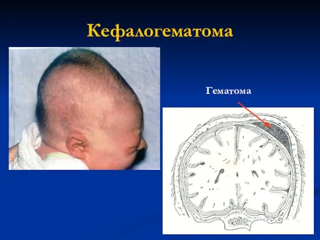 Кефалогематома Гематома