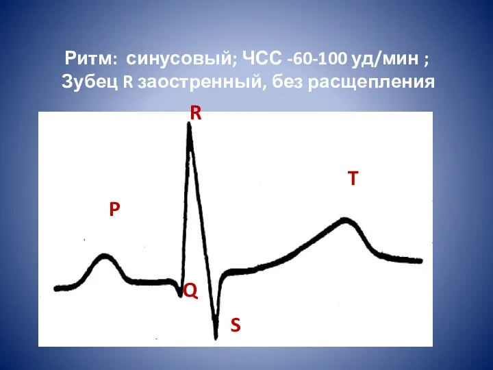 Ритм: синусовый; ЧСС -60-100 уд/мин ; Зубец R заостренный, без расщепления P Q S T R