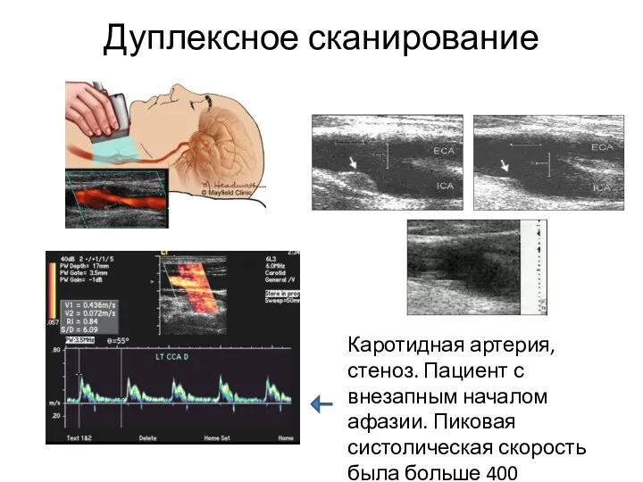 Дуплексное сканирование Каротидная артерия, стеноз. Пациент с внезапным началом афазии. Пиковая систолическая скорость была больше 400