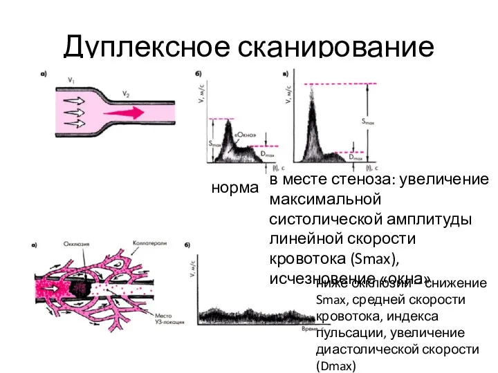 Дуплексное сканирование норма в месте стеноза: увеличение максимальной систолической амплитуды