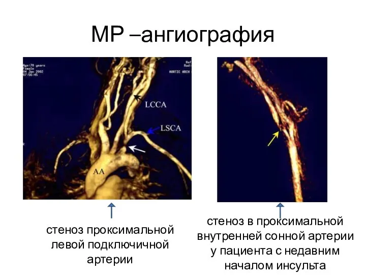 МР –ангиография стеноз в проксимальной внутренней сонной артерии у пациента