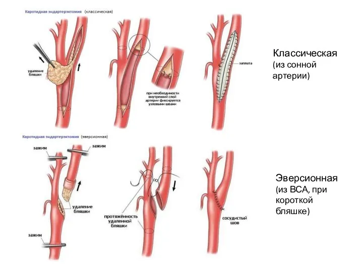 Классическая (из сонной артерии) Эверсионная (из ВСА, при короткой бляшке)