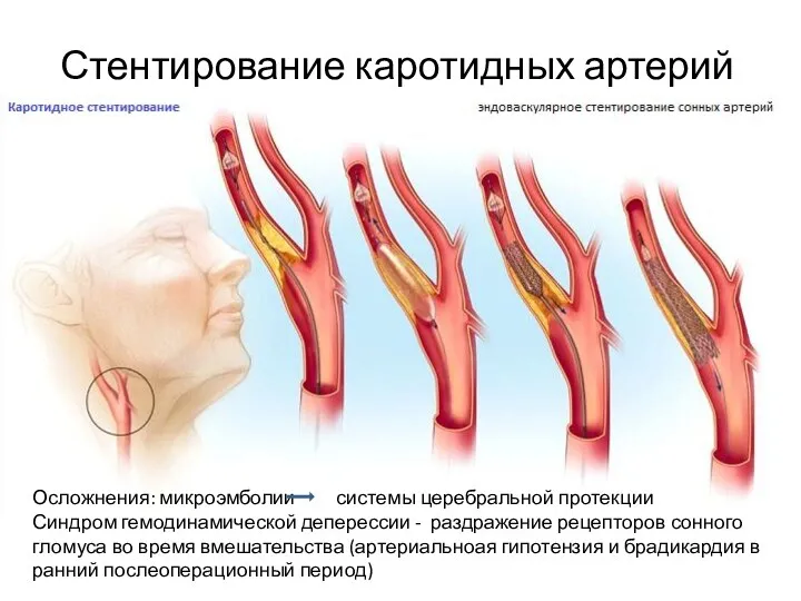 Стентирование каротидных артерий Осложнения: микроэмболии системы церебральной протекции Синдром гемодинамической
