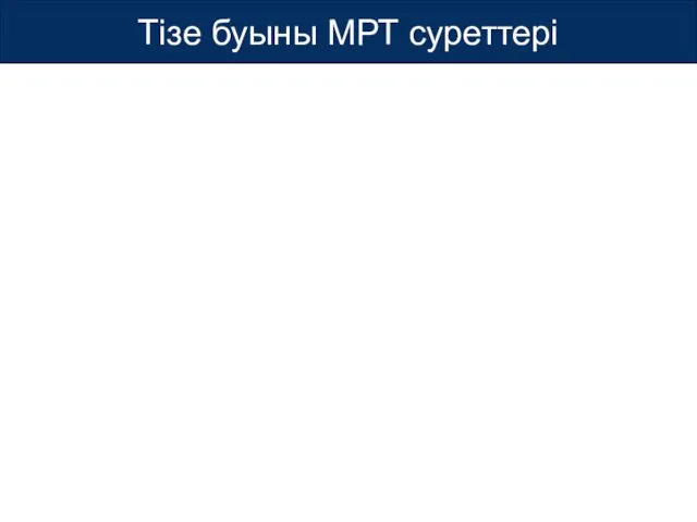 Тізе буыны МРТ суреттері