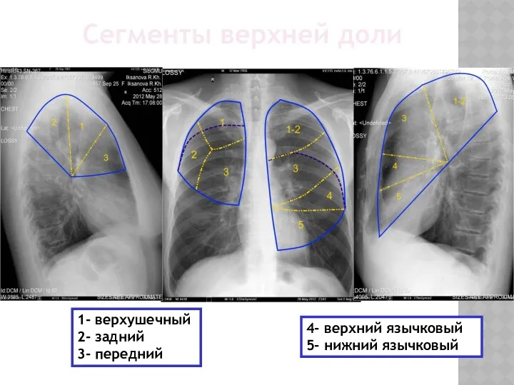 Сегменты верхней доли 1- верхушечный 2- задний 3- передний 4- верхний язычковый 5- нижний язычковый